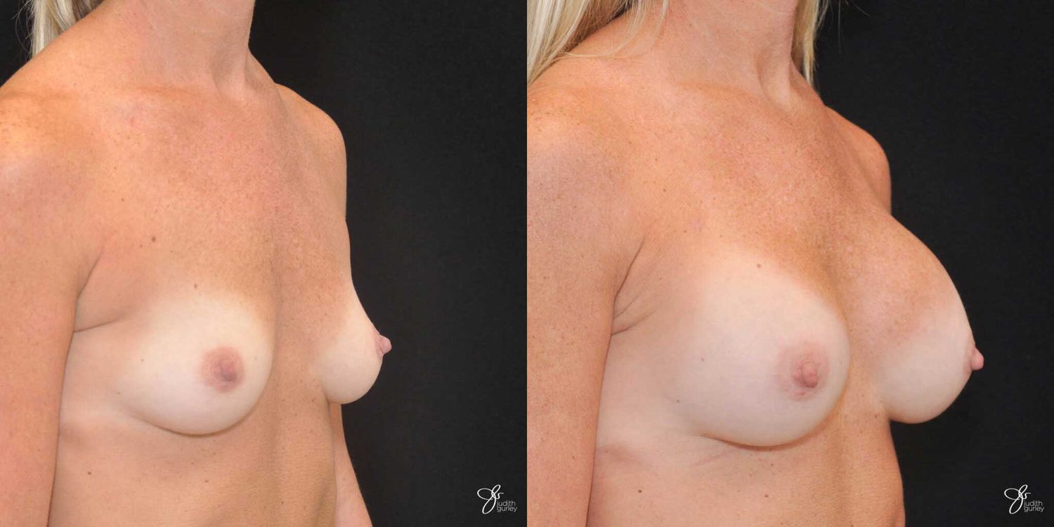 Breast Augmentation Before & After