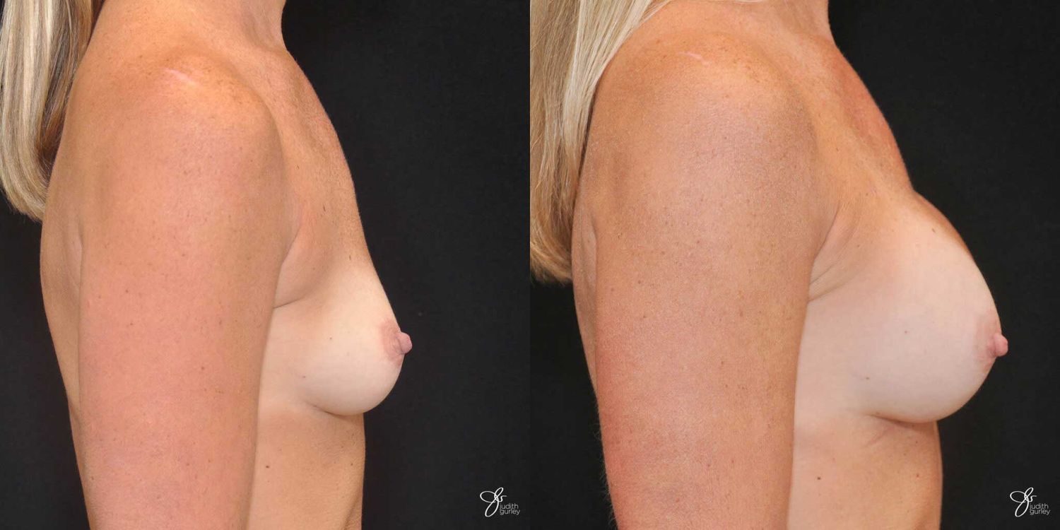 Breast Augmentation Before & After