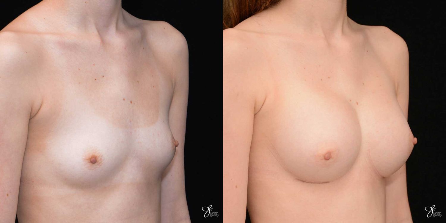 Breast Augmentation Before & After