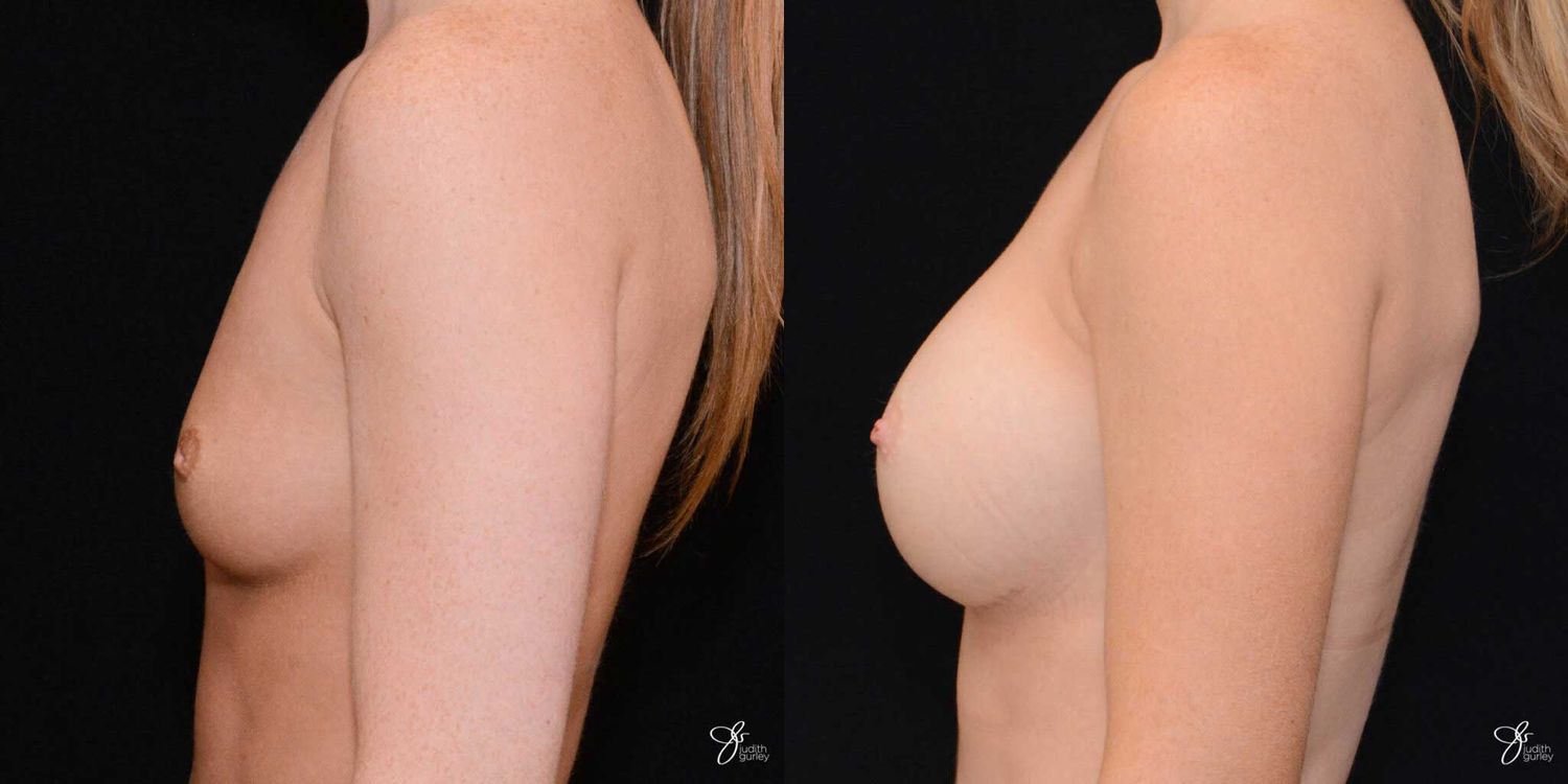 Breast Augmentation Before & After