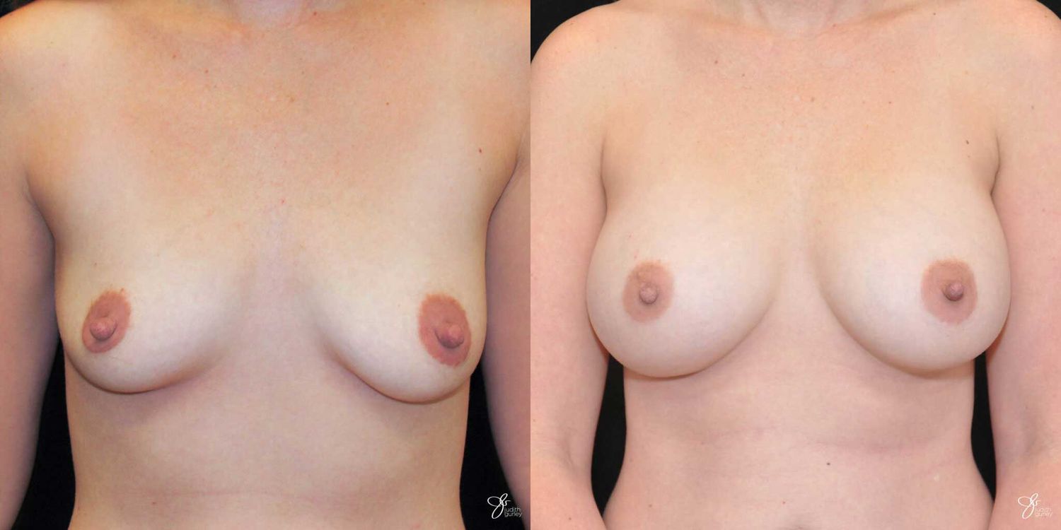Breast Augmentation Before & After