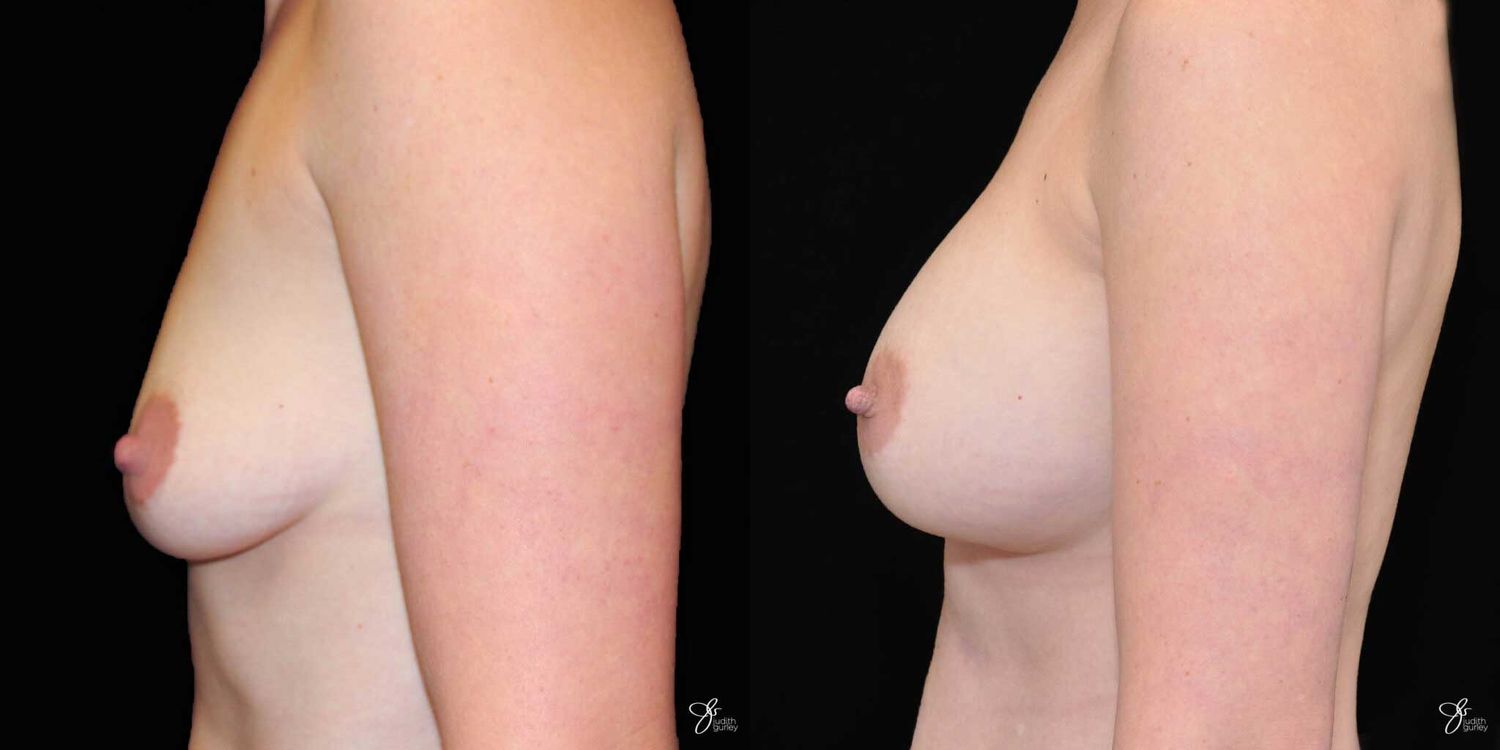 Breast Augmentation Before & After