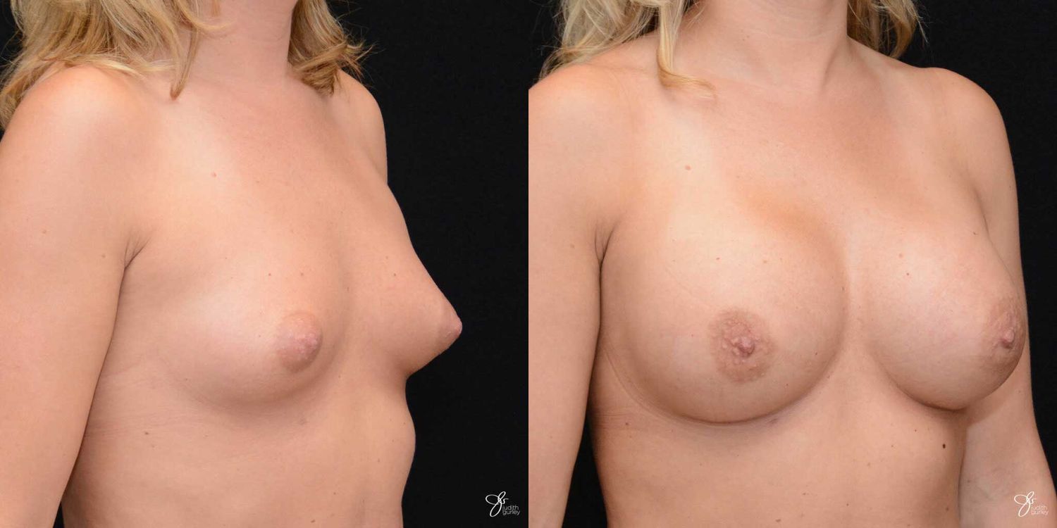 Breast Augmentation Before & After