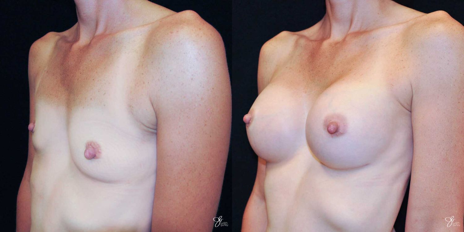 Breast Augmentation Before & After