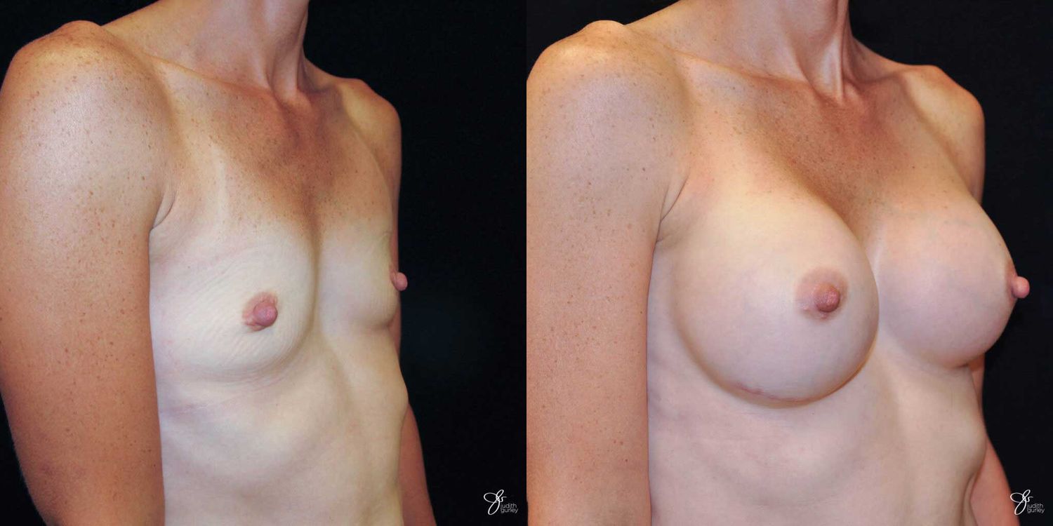 Breast Augmentation Before & After