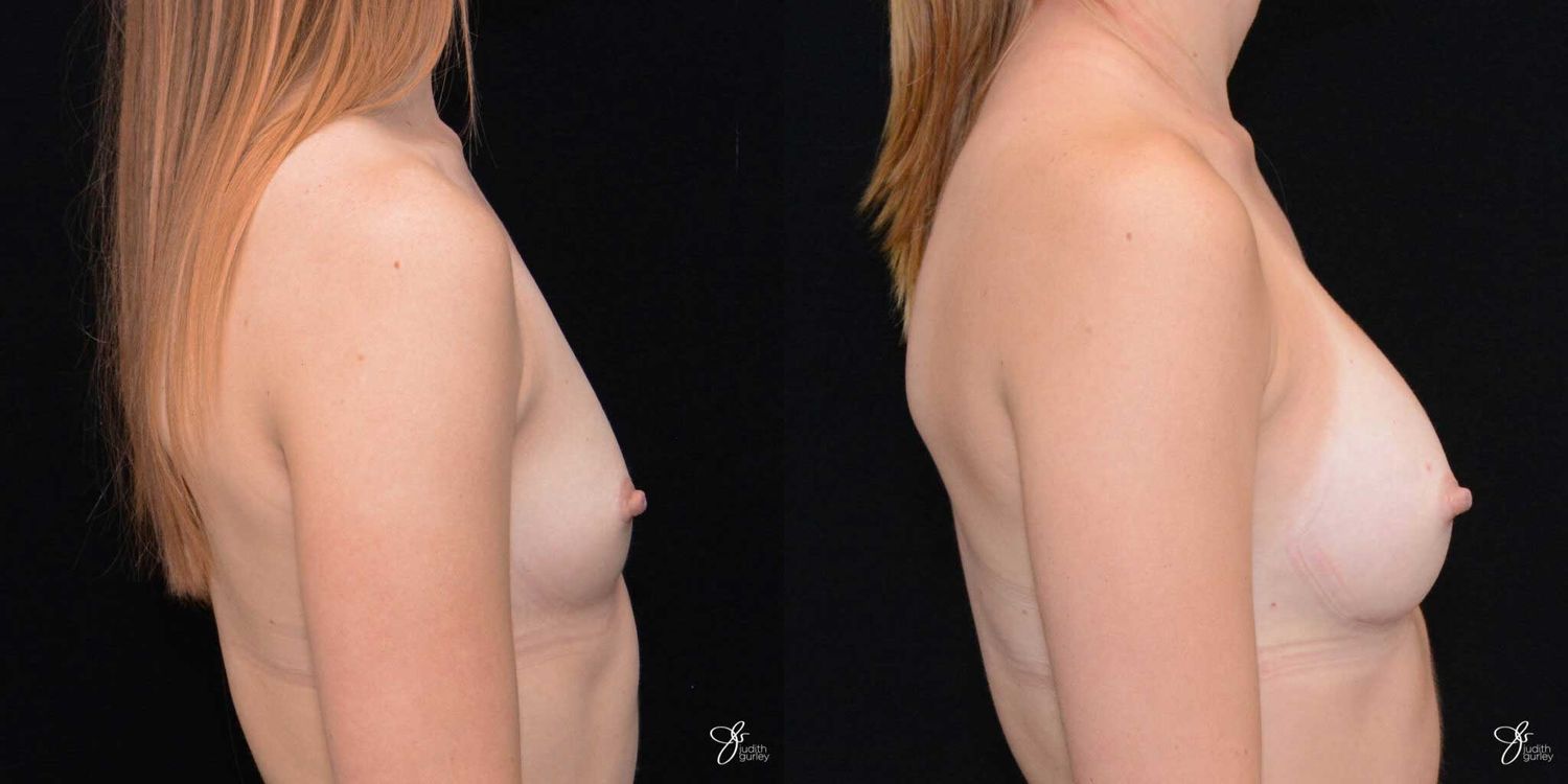Breast Augmentation Before & After