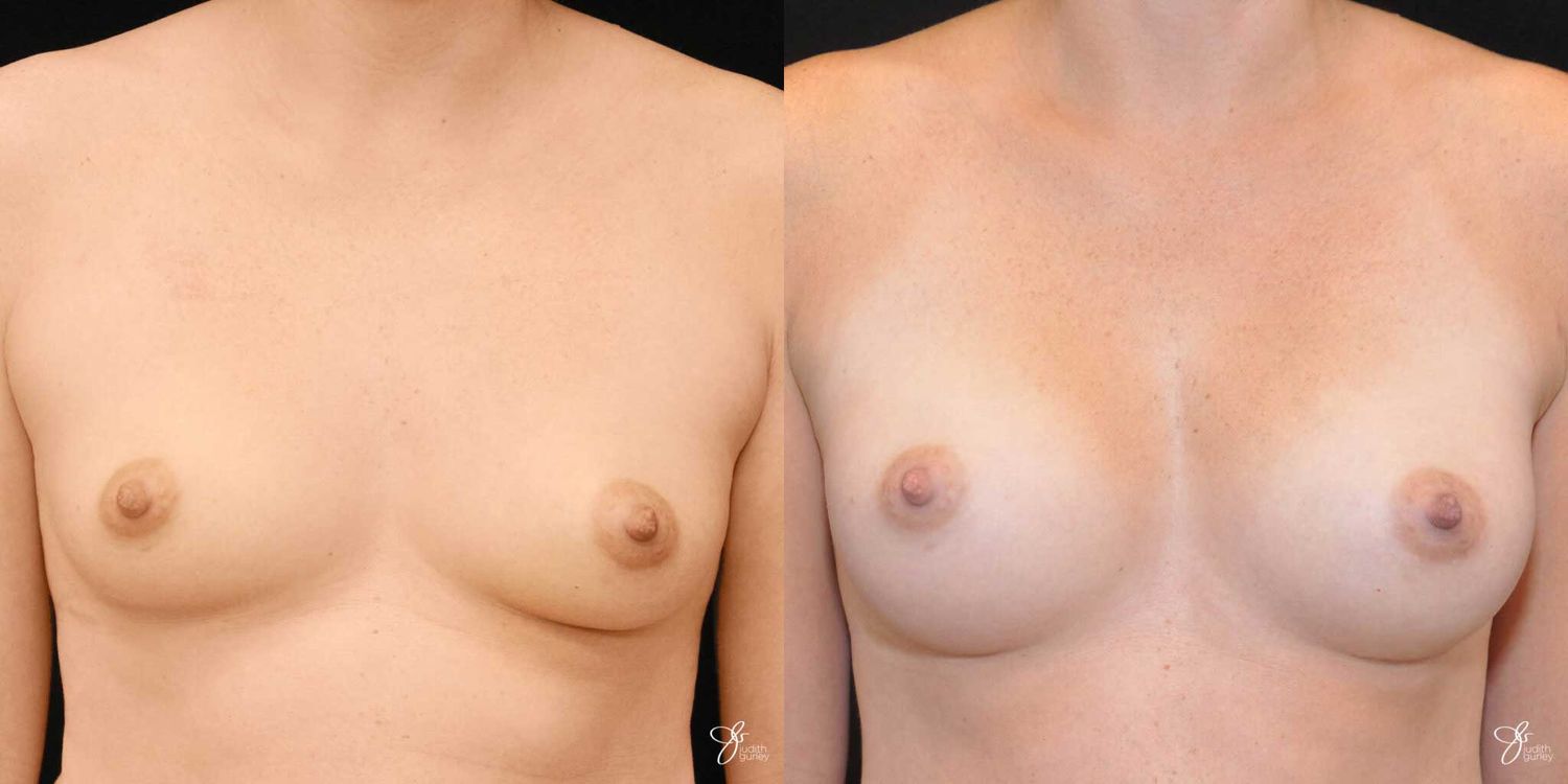 Breast Augmentation Before & After