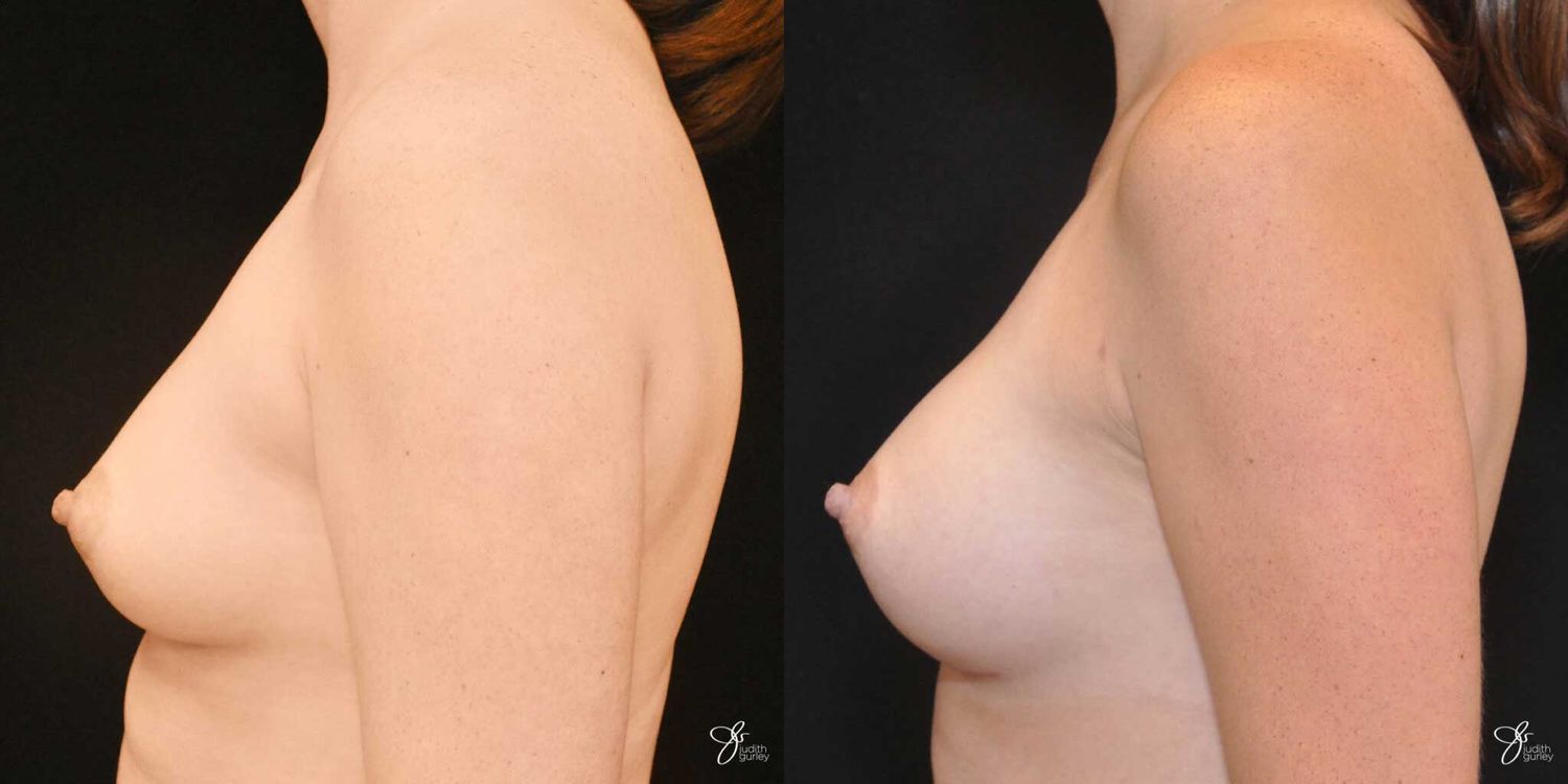 Breast Augmentation Before & After
