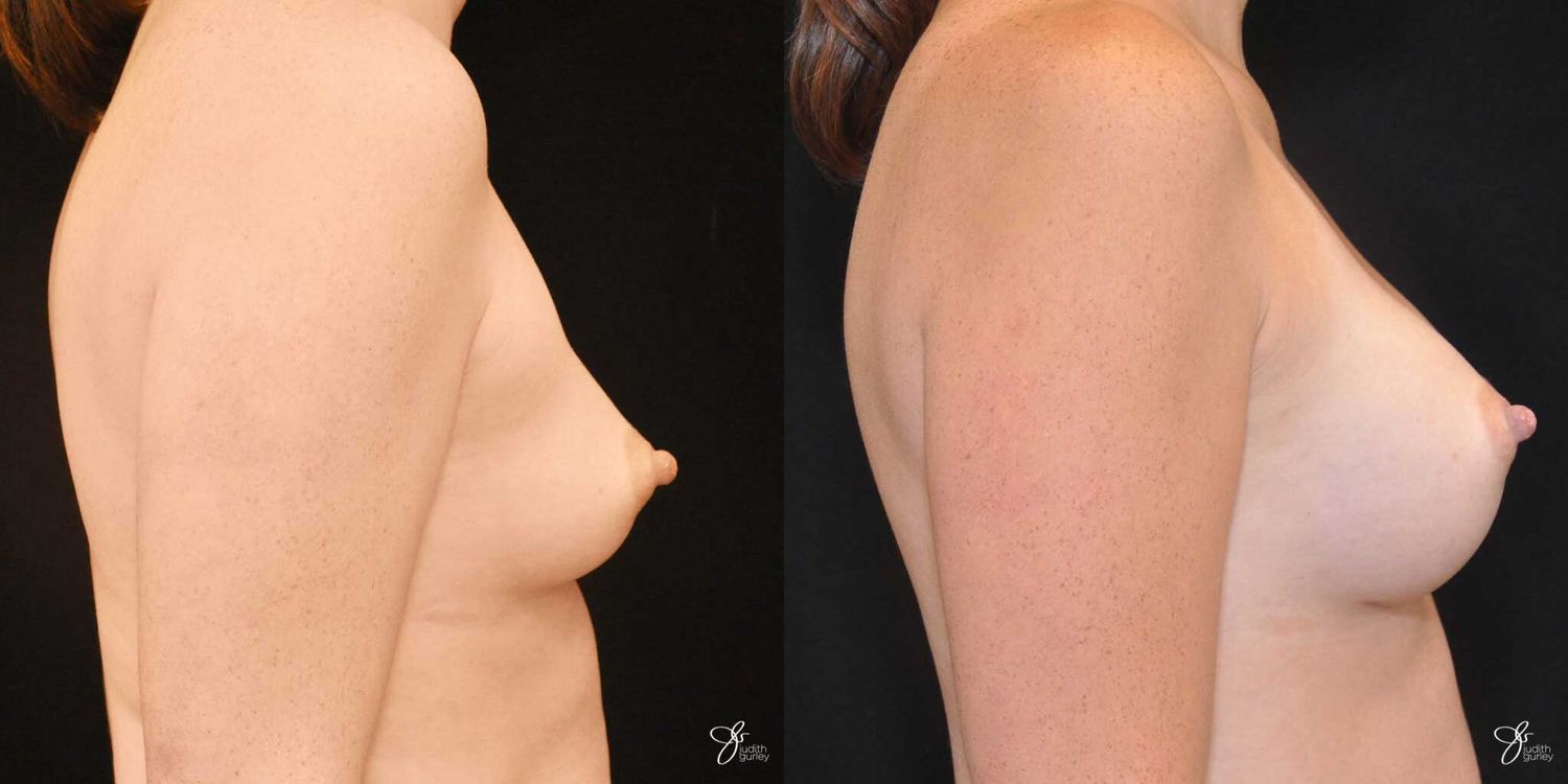 Breast Augmentation Before & After
