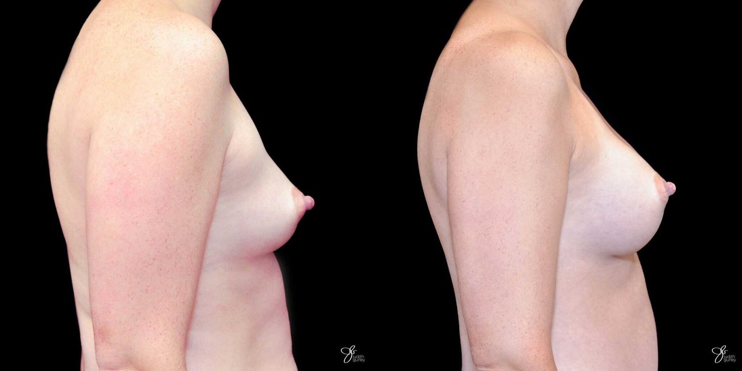 Breast Augmentation Before & After