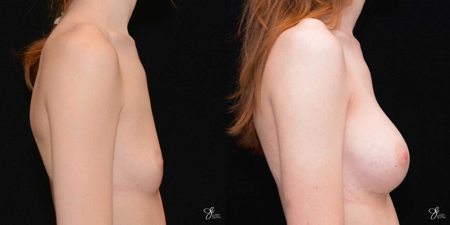 Breast Augmentation Before & After