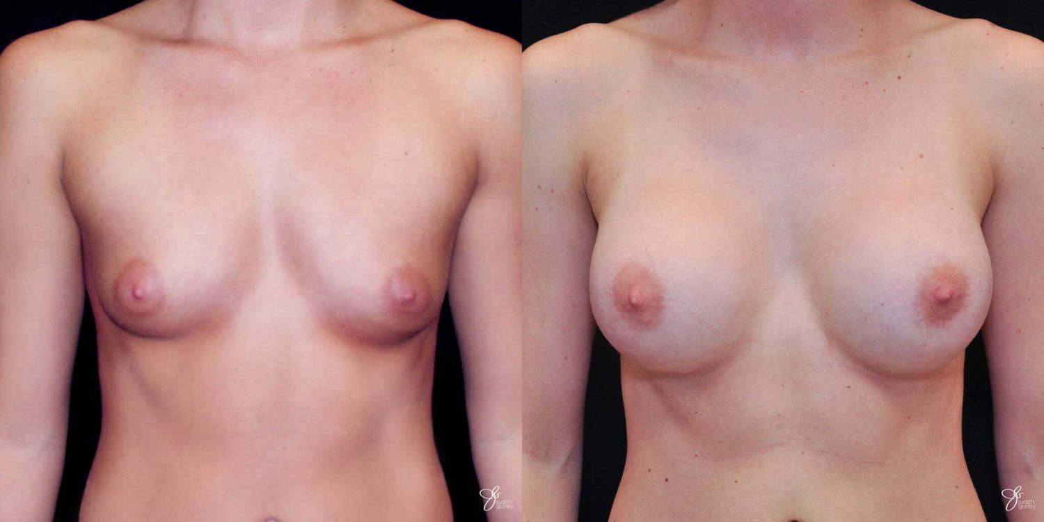 Breast Augmentation Before & After