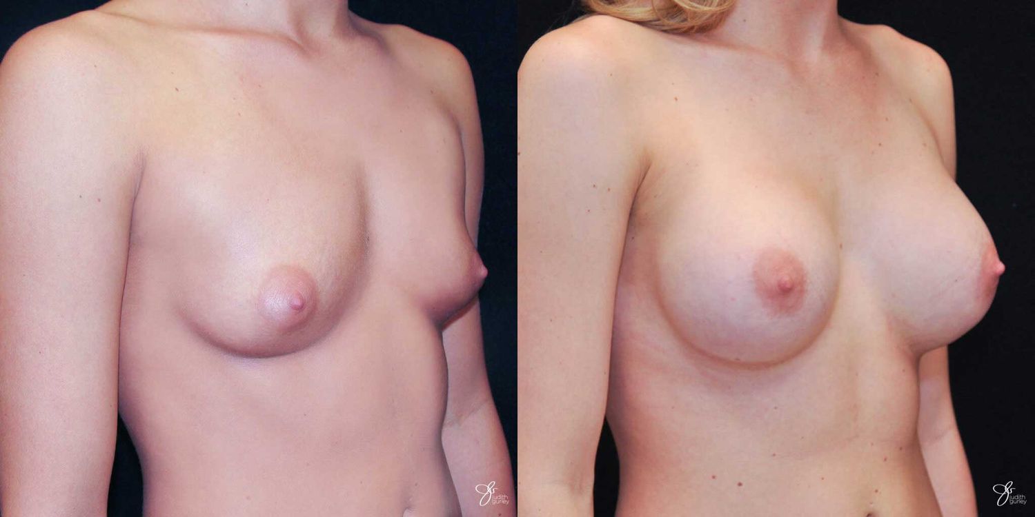 Breast Augmentation Before & After