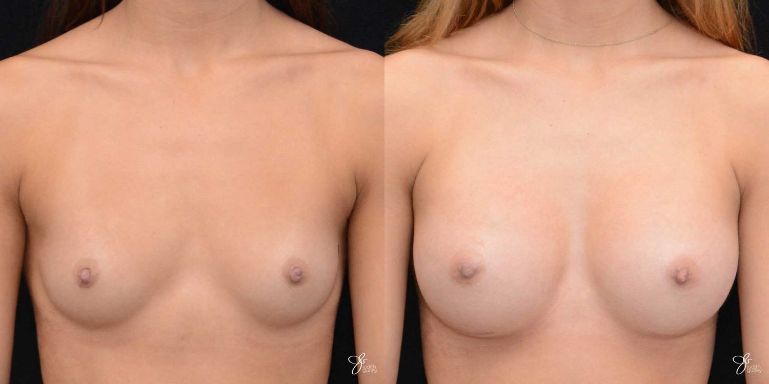 Breast Augmentation Before & After
