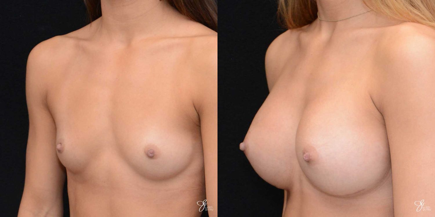 Breast Augmentation Before & After