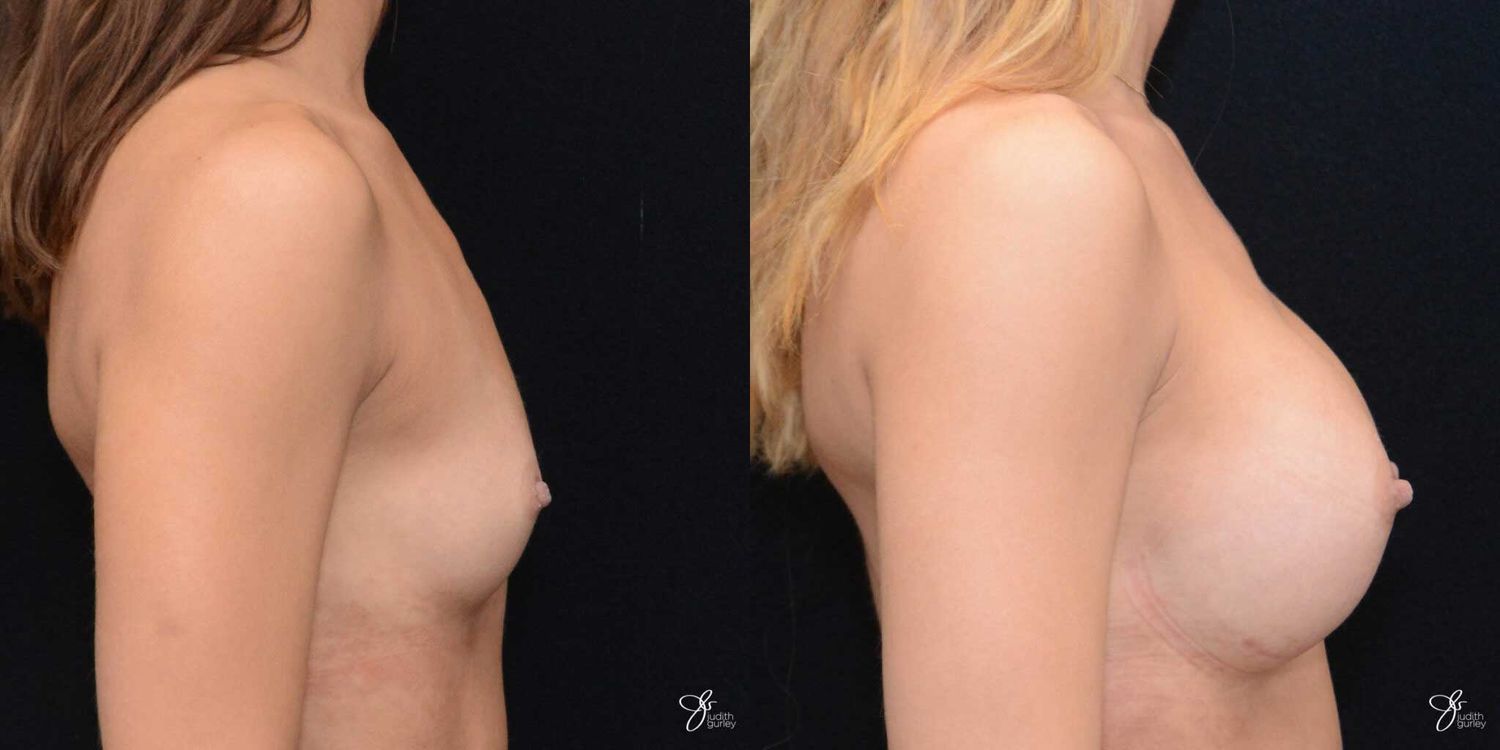 Breast Augmentation Before & After