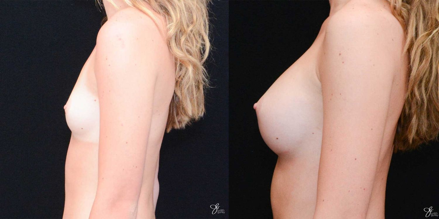 Breast Augmentation Before & After