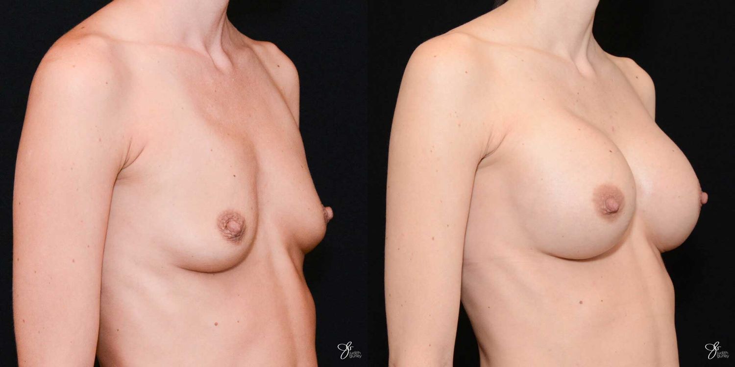 Breast Augmentation Before & After
