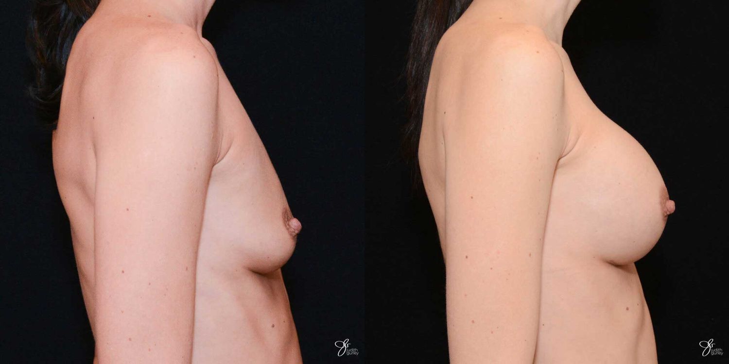 Breast Augmentation Before & After