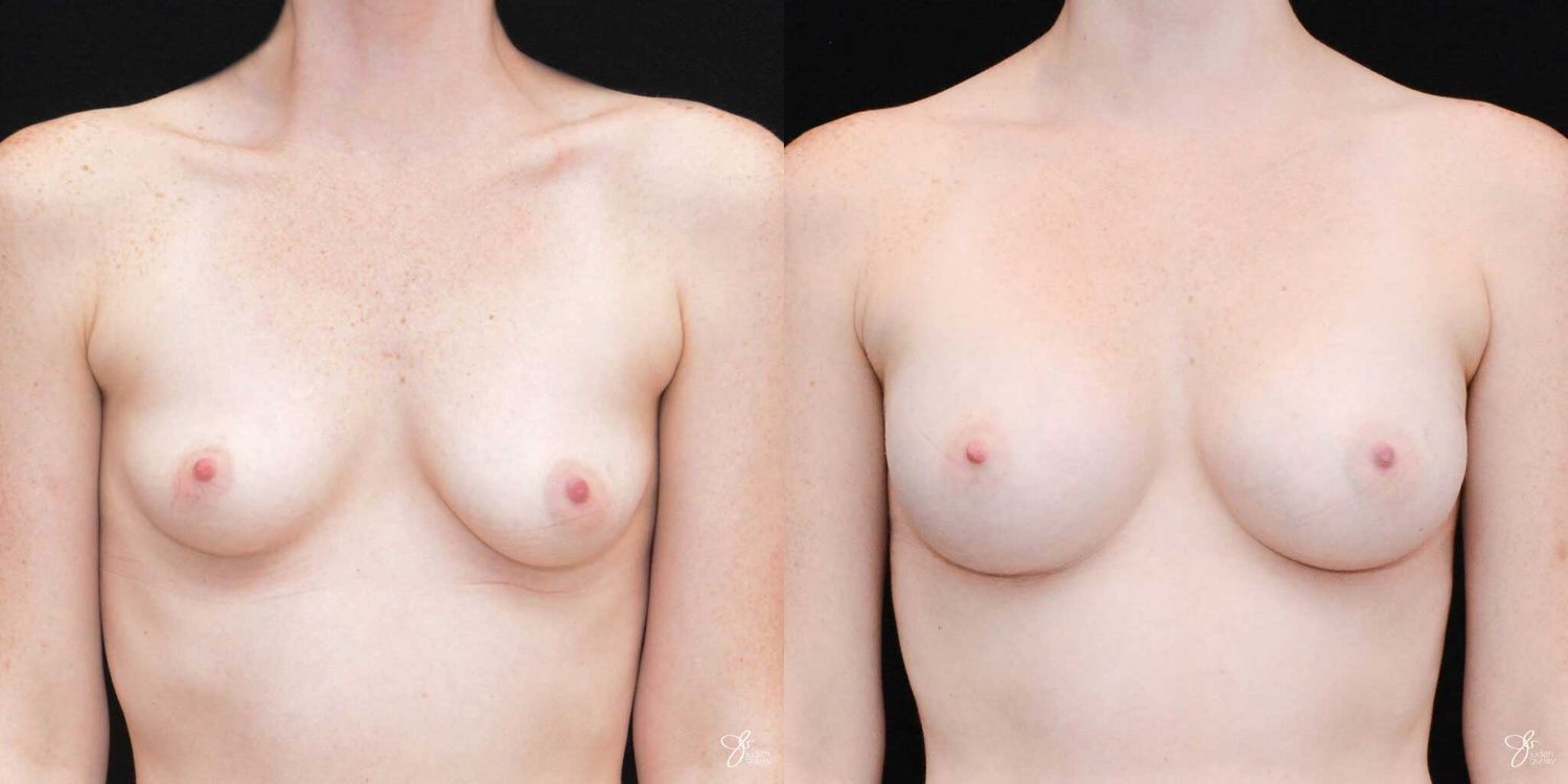 Breast Augmentation Before & After