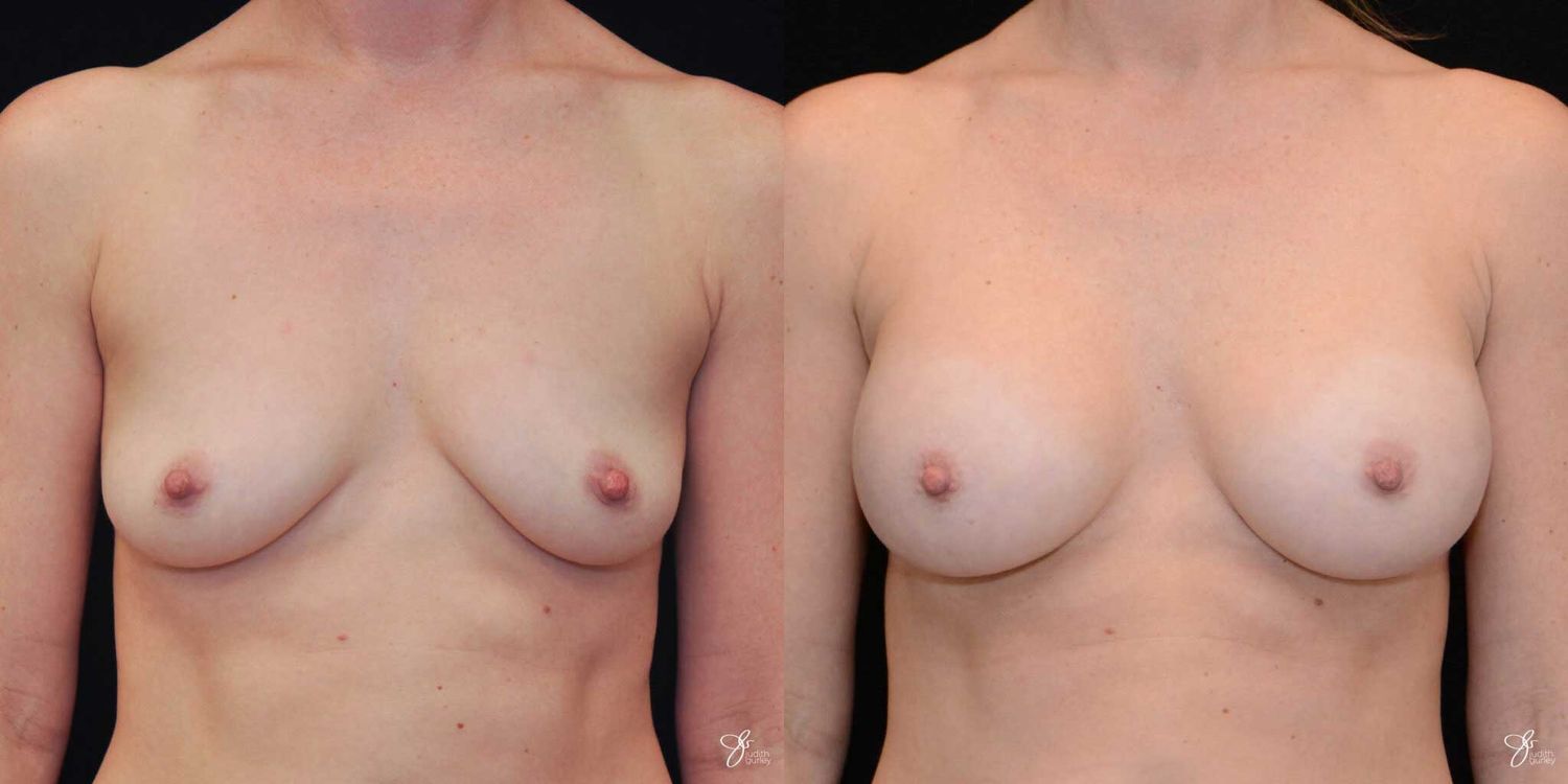 Breast Augmentation Before & After