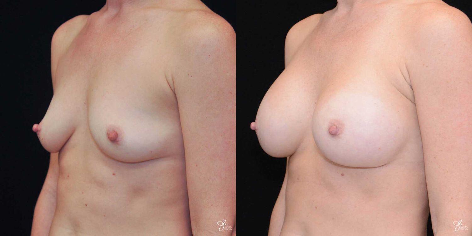 Breast Augmentation Before & After