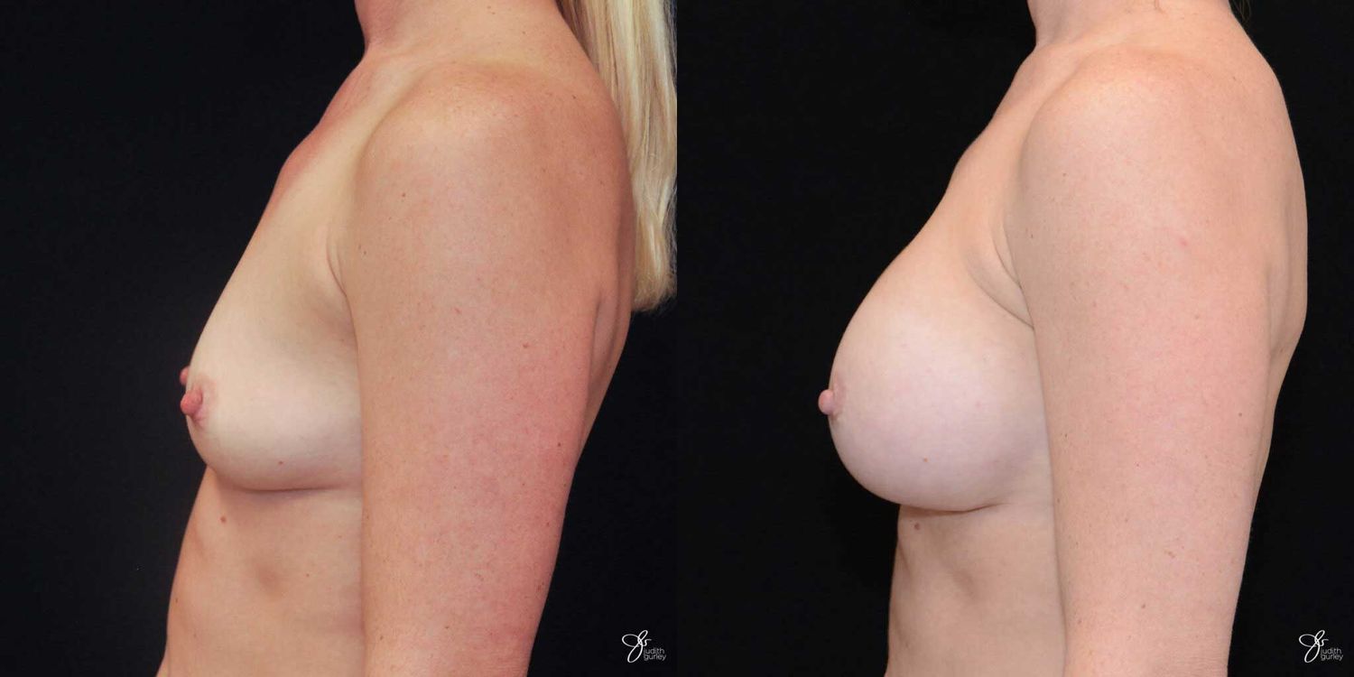 Breast Augmentation Before & After