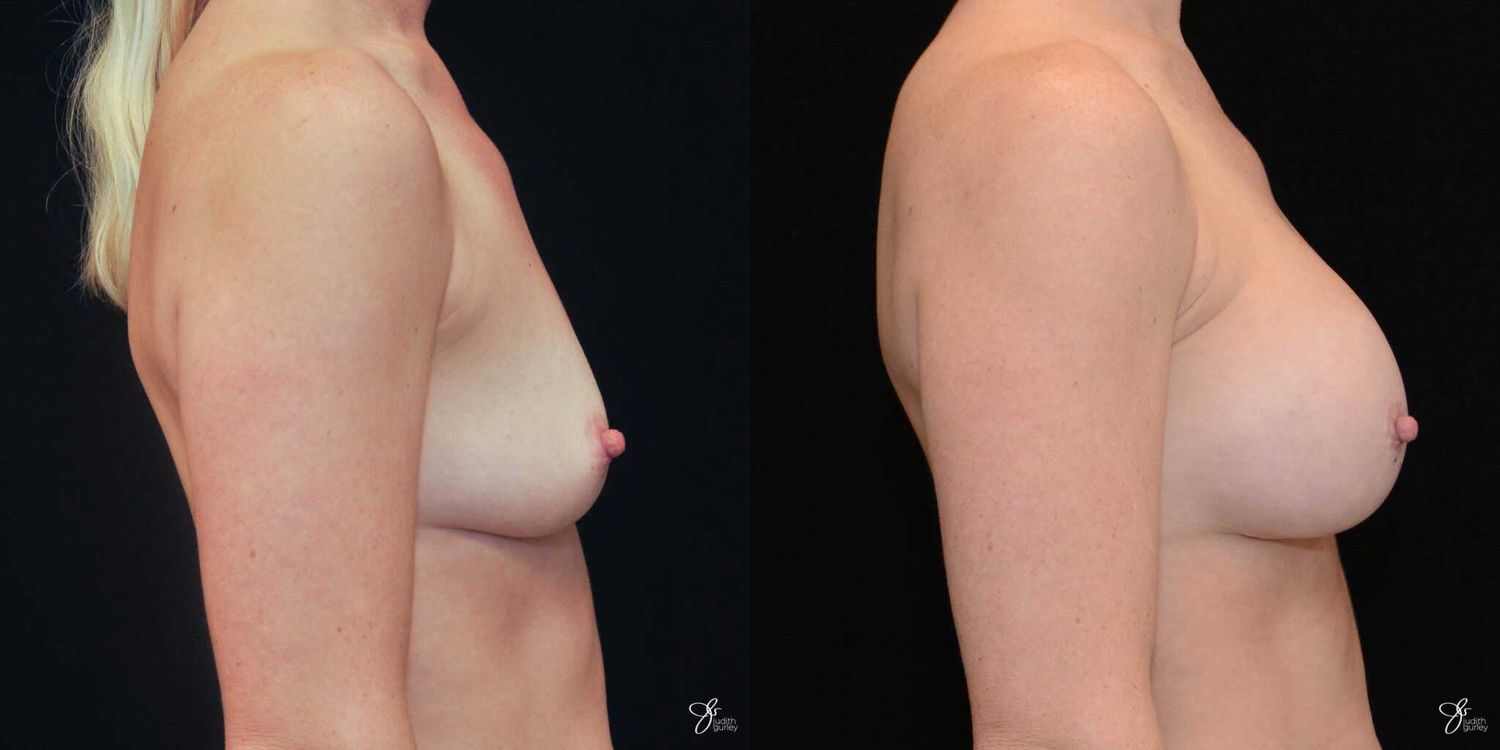 Breast Augmentation Before & After
