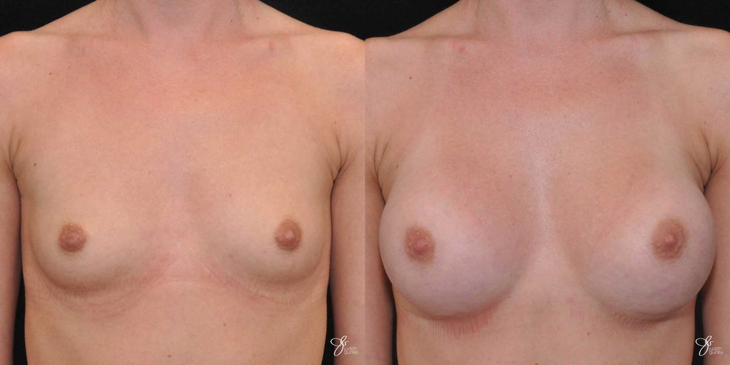 Breast Augmentation Before & After