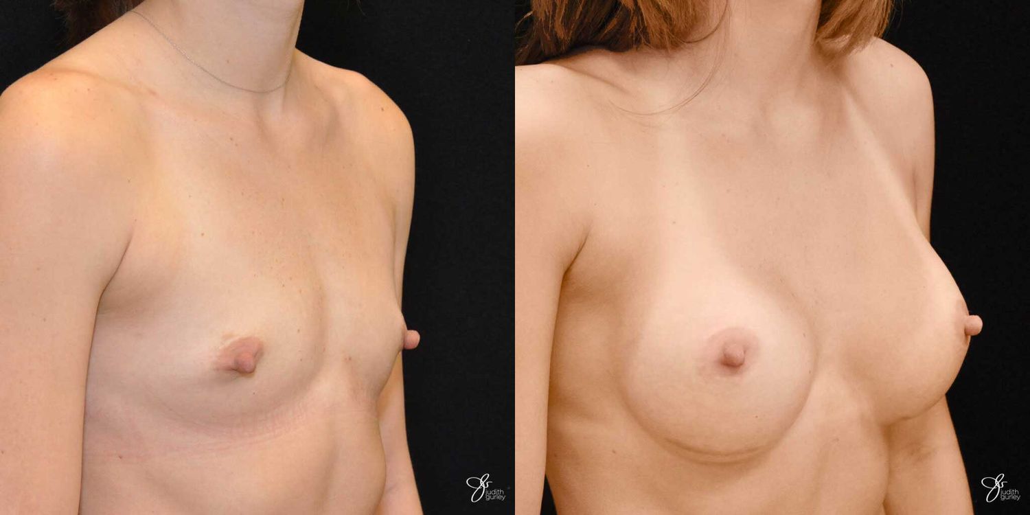 Breast Augmentation Before & After