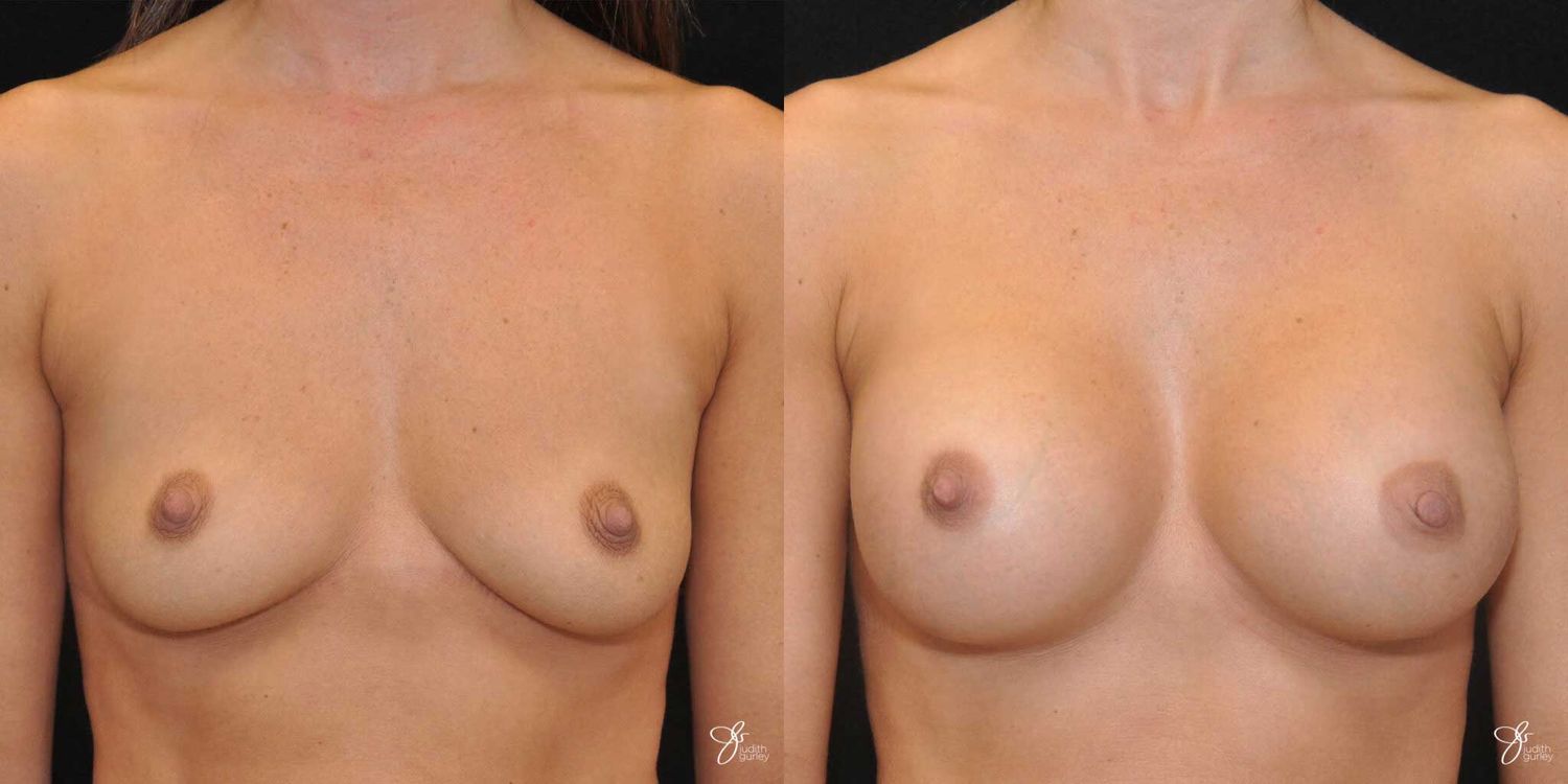 Breast Augmentation Before & After