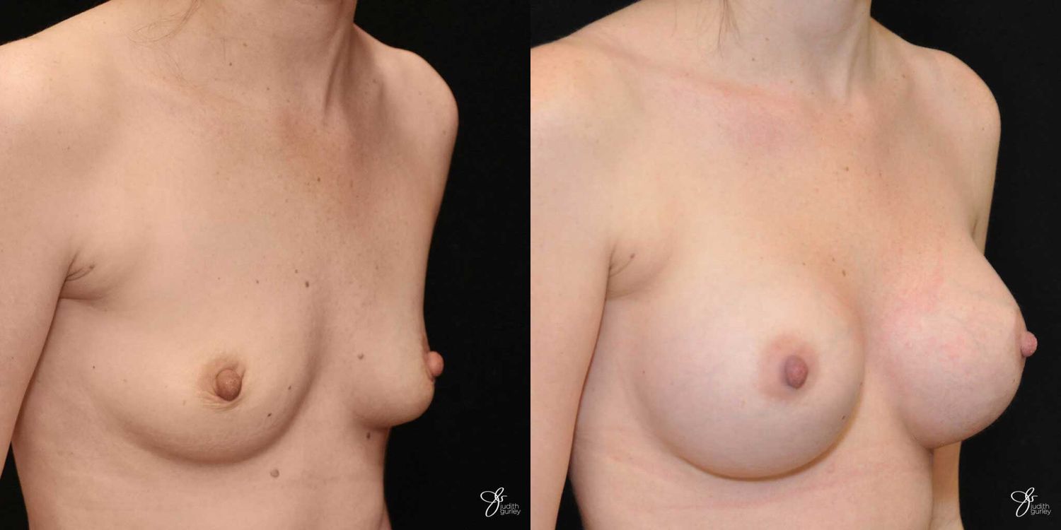 Breast Augmentation Before & After