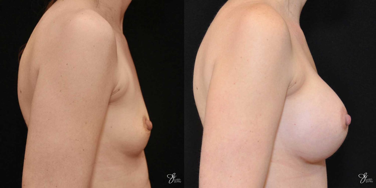Breast Augmentation Before & After