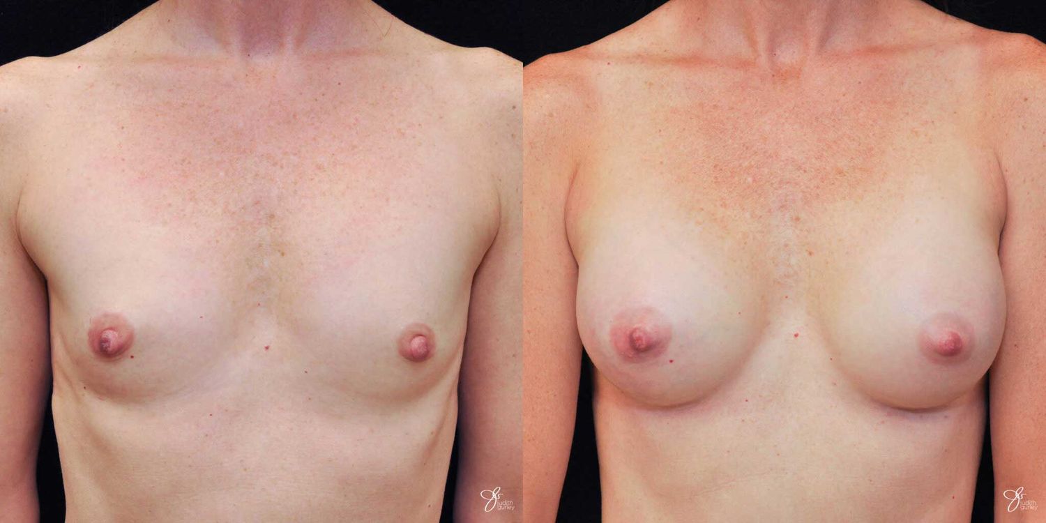 Breast Augmentation Before & After