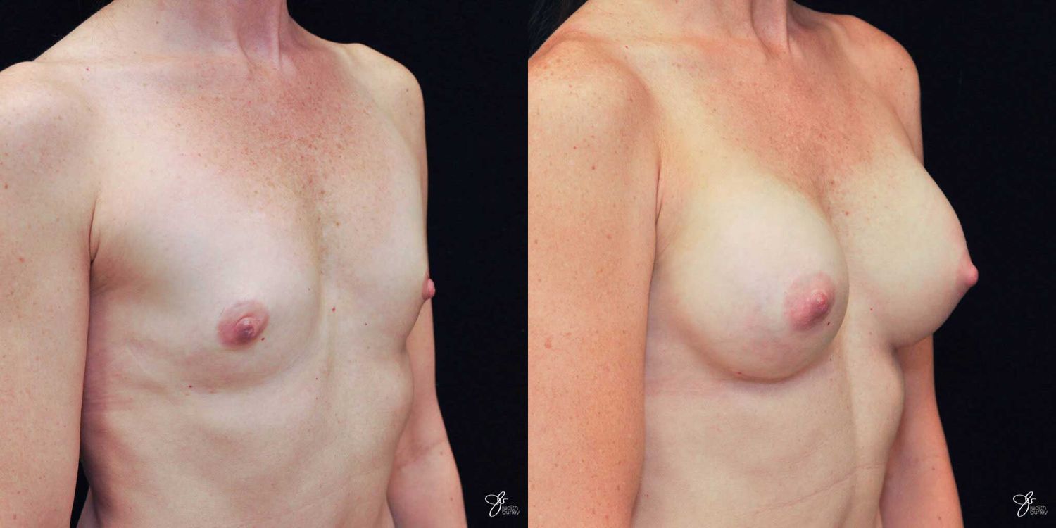 Breast Augmentation Before & After