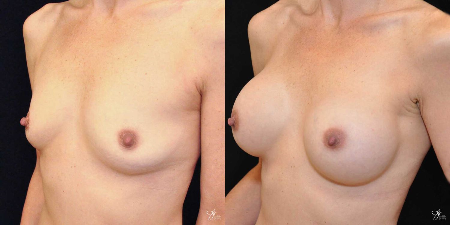 Breast Augmentation Before & After