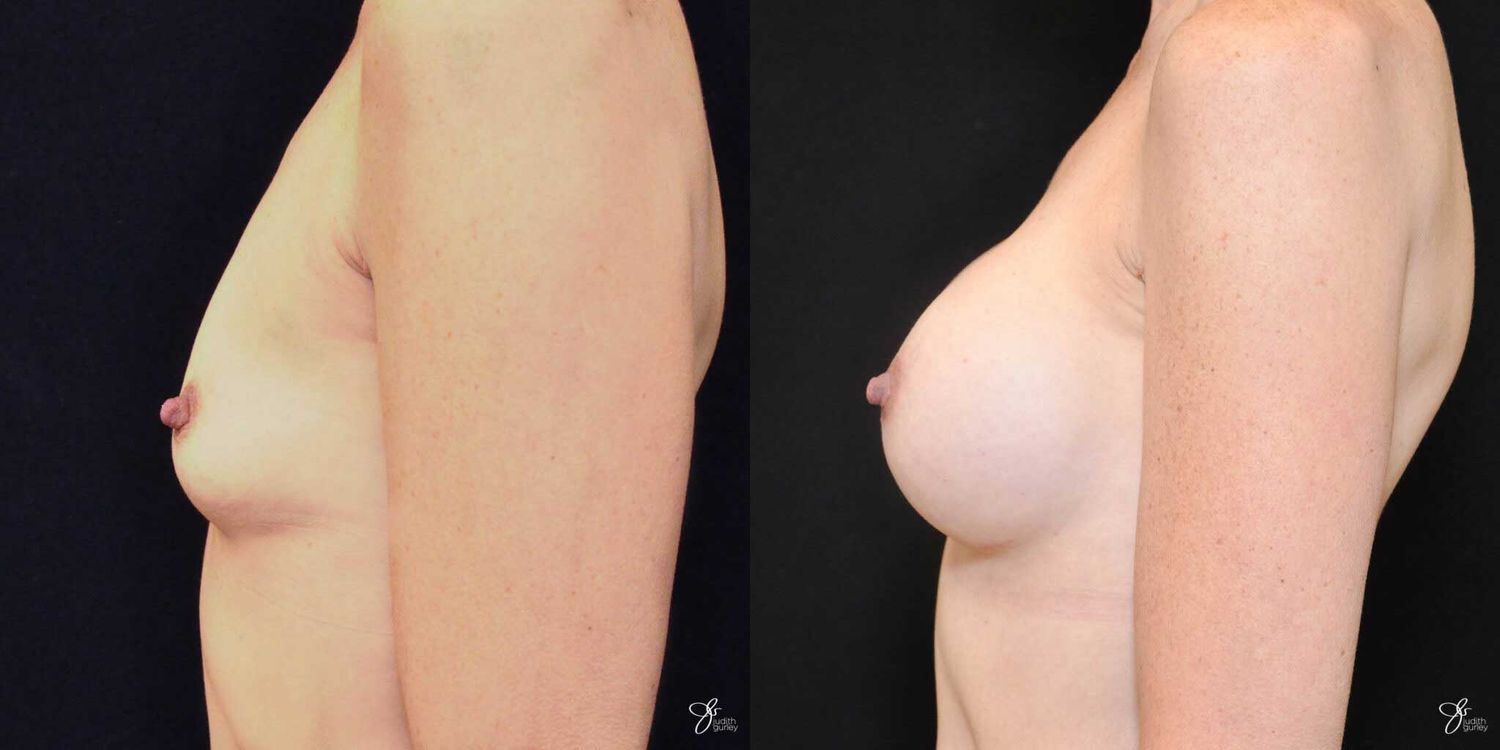 Breast Augmentation Before & After