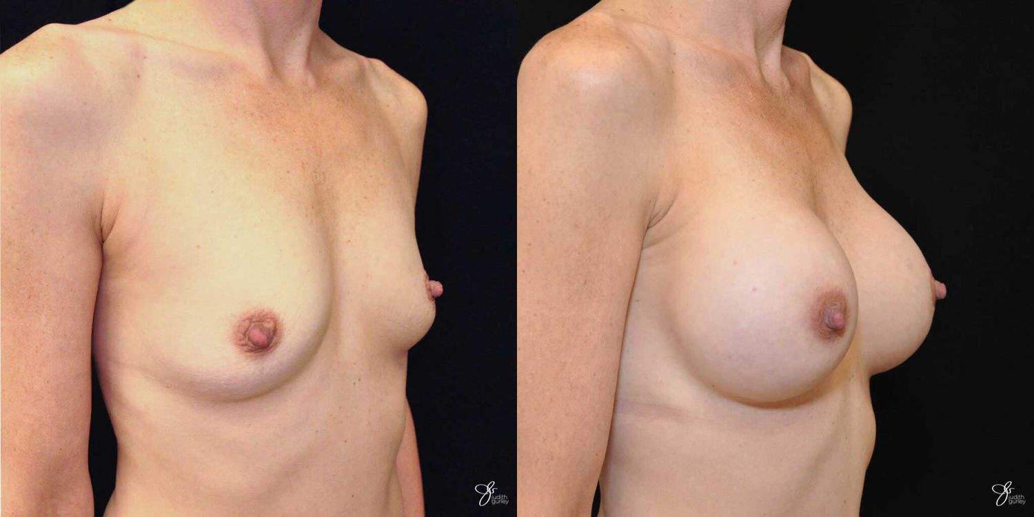 Breast Augmentation Before & After
