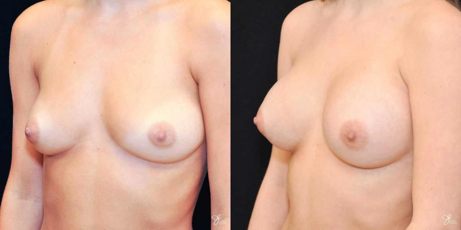 Breast Augmentation Before & After