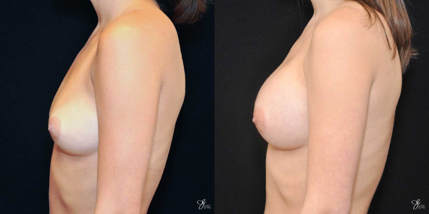 Breast Augmentation Before & After