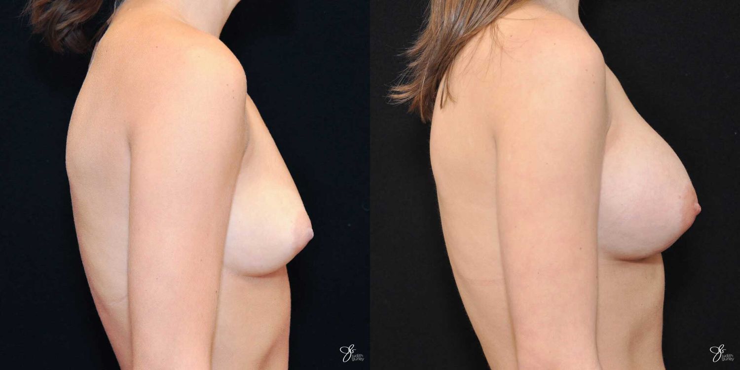 Breast Augmentation Before & After
