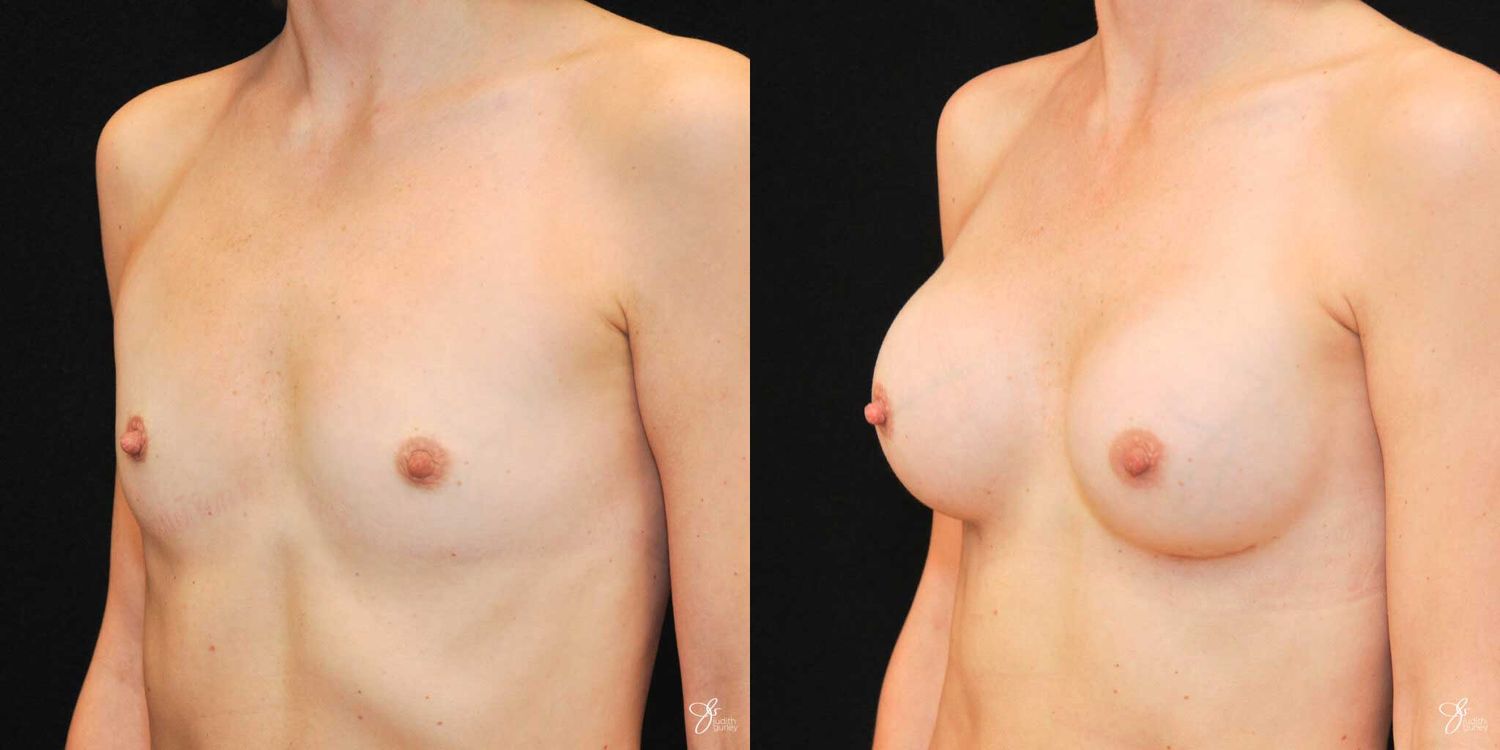 Breast Augmentation Before & After