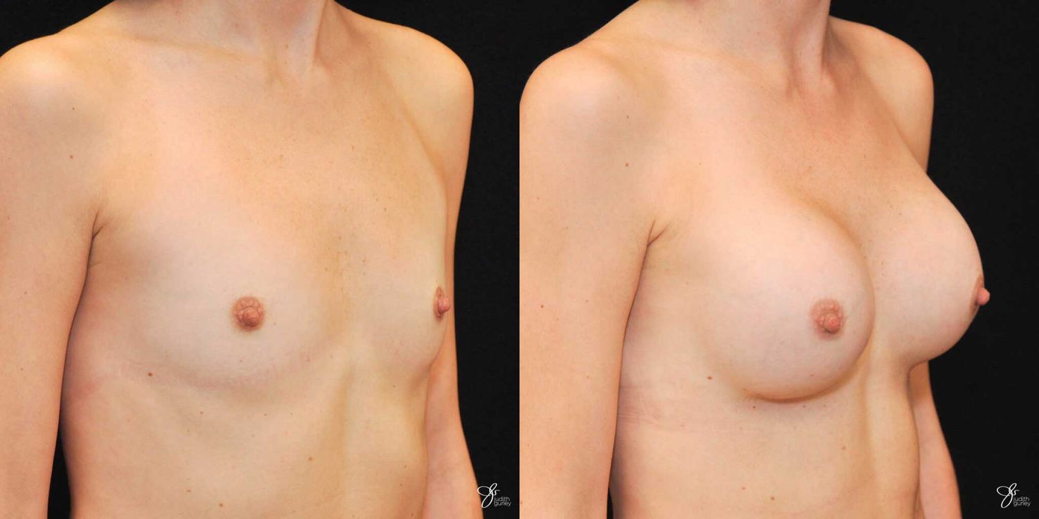 Breast Augmentation Before & After