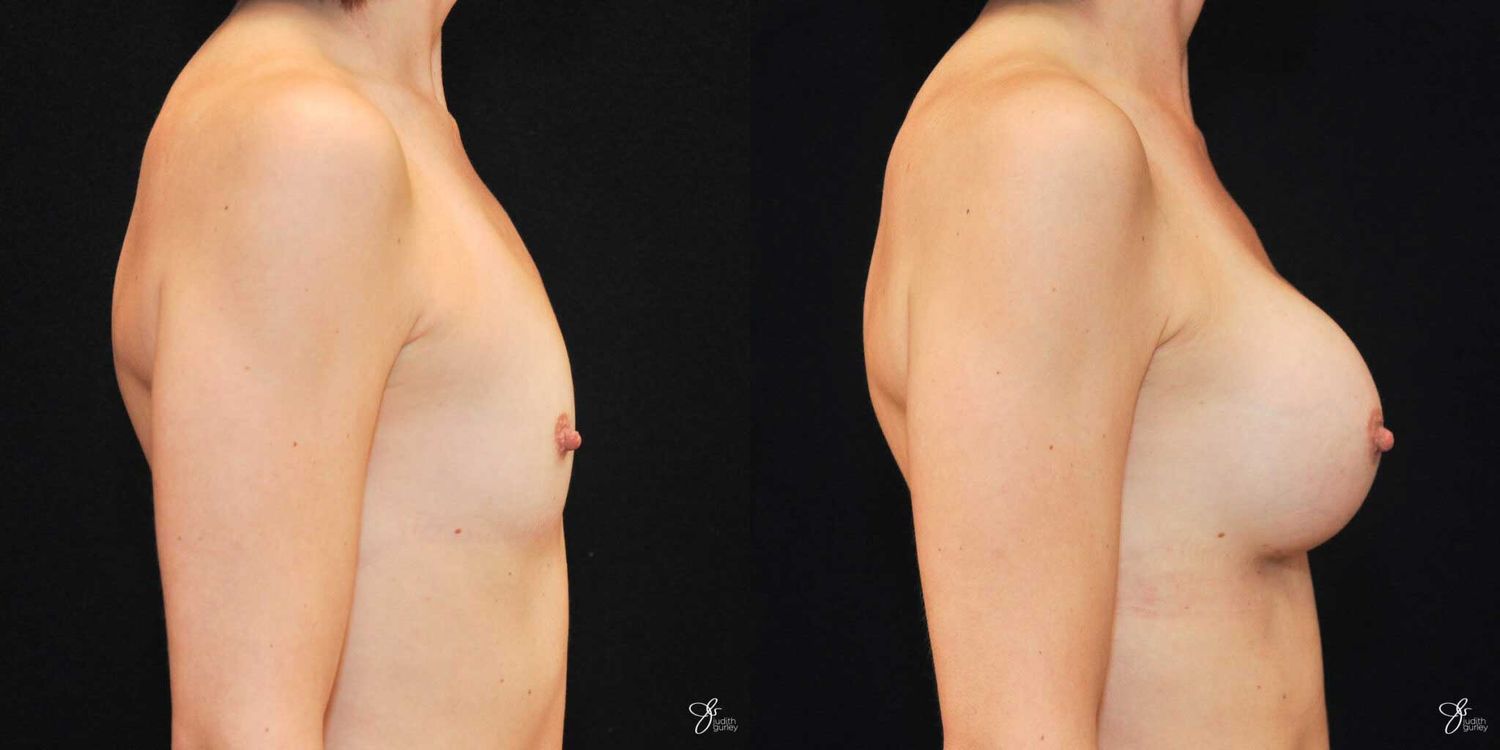 Breast Augmentation Before & After