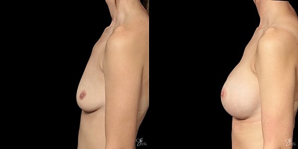 Breast Augmentation Before & After