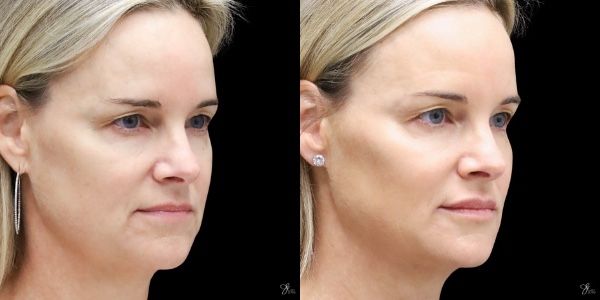 Facial Rejuvenation Before & After