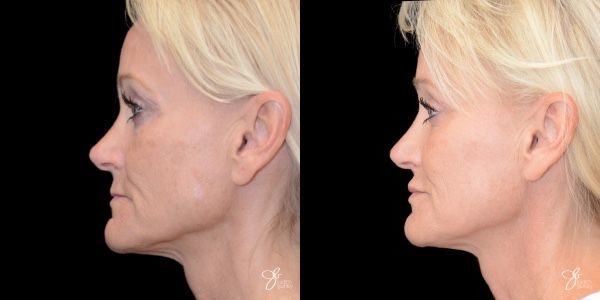 Facial Rejuvenation Before & After