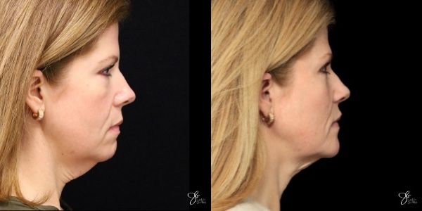 Facial Rejuvenation Before & After