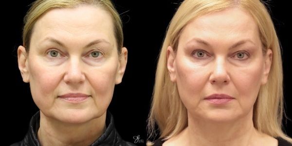 Facial Rejuvenation Before & After