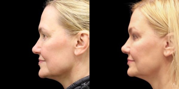 Facial Rejuvenation Before & After